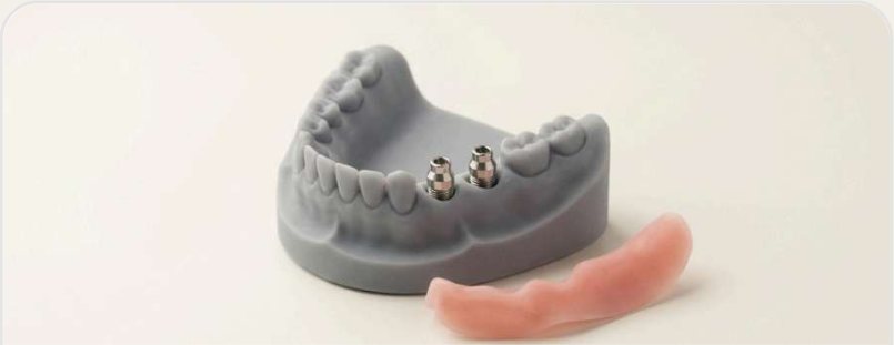 Printed implant model with analogs and a removable soft gingival mask