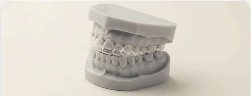 Printed orthodontic study models of an upper and lower arch in occlusion