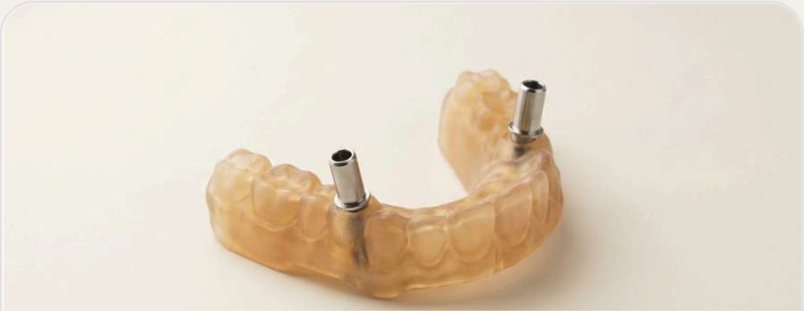 Printed surgical guide with metal drill sleeves seated in the guide body