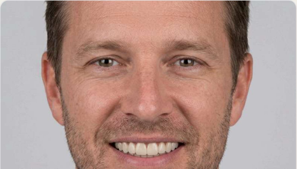 The same portrait with a simulated treatment result applied to the upper anterior teeth